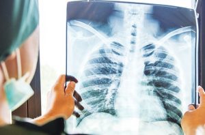 Pandemi, Temuan Kasus TB Tanah Air Merosot Tajam