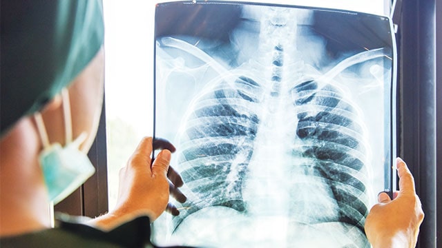 Pandemi, Temuan Kasus TB Tanah Air Merosot Tajam