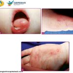 Ilustrasi flu singapura. Foto: Kemenkes