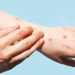 Ilustrasi monkeypox. Foto: Freepik