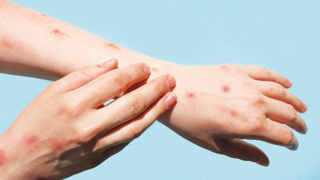 Ilustrasi monkeypox. Foto: Freepik