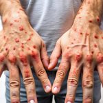 Ilustrasi monkeypox. Foto: Freepik